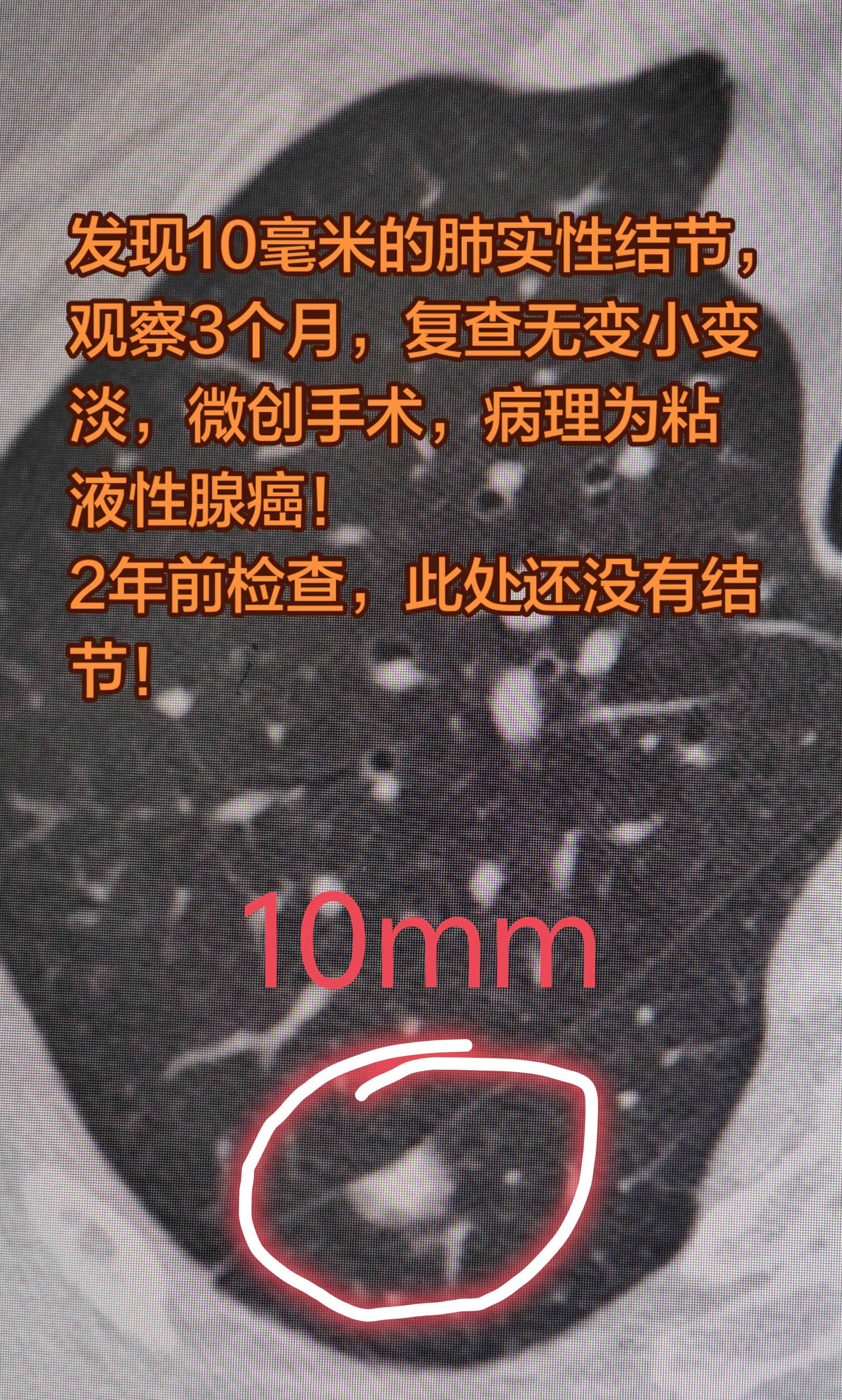 肺结节与肺癌。发现10毫米的肺实性结节，观察3个月，复查无变小变淡，微...