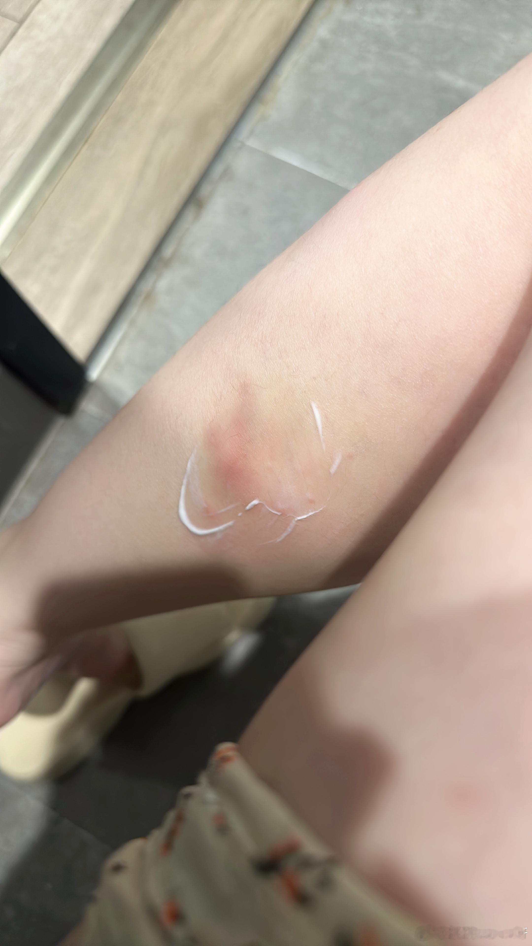 到底什么虫子咬我了😖​​​