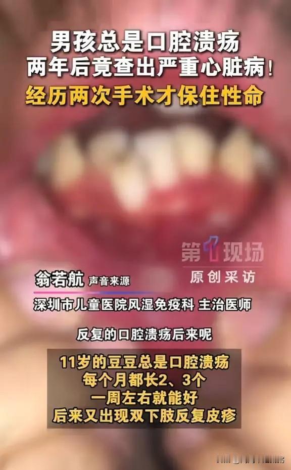 真是万万没想到！5月26日，广东深圳，一个男孩经常长口腔溃疡，嘴巴和舌头轮着溃烂