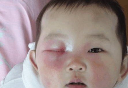宝宝出生后头上长脓包, 妈妈急坏了, 医院一查乐了