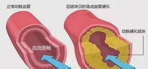 血脂是血管的定时炸弹! 此物一天3克血管干干净净, 现在就用