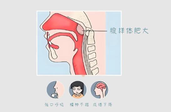 孩子腺样体肥大，4种食物经常吃，天然的“通窍护鼻剂”！家长们都知道，孩子