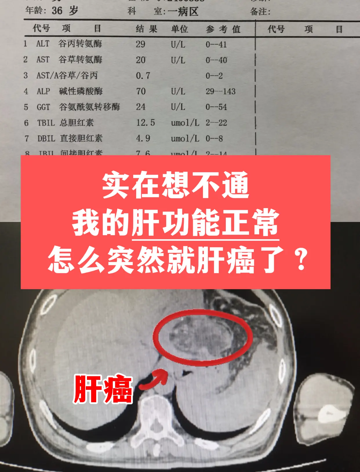 肝功能正常也可能会肝癌 门诊上遇到一位山东的患者，有乙肝好多年，平时能...