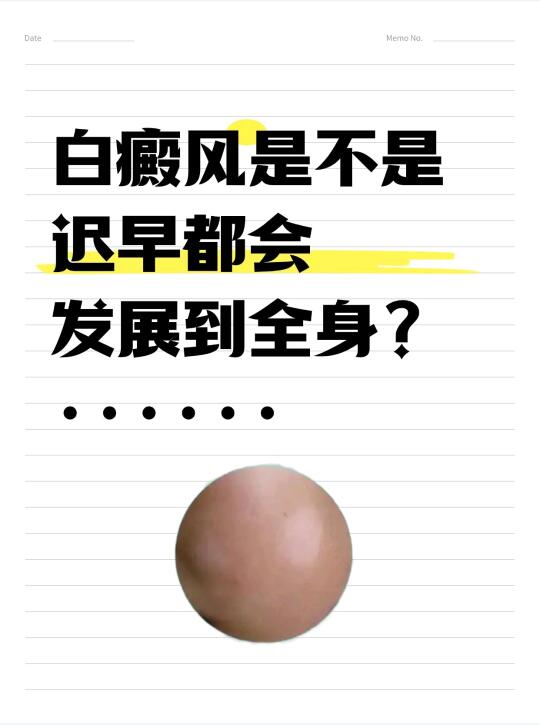 😯白癜风是不是迟早都会发展到全身?白癜风并不一定会发展到全身，以下是...