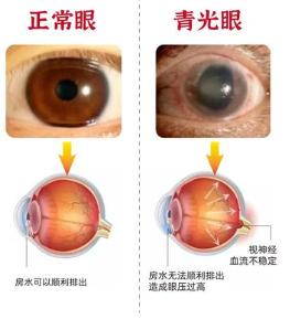 眼睛竟会悄悄失明？别等看不见才知道青光眼眼睛竟会悄悄失明？别等看不见才知道青光
