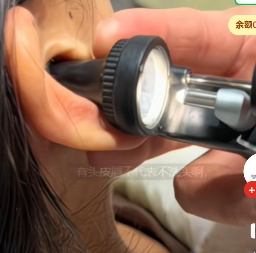 医生说女子耳道状态非常严重，异物松动的瞬间，女子急忙推开医生的器械，医生大喊