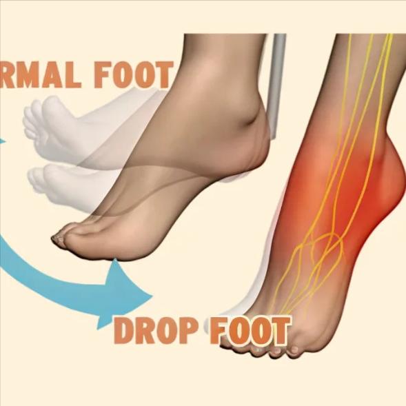 足下垂别大意！教你4个改善方法，走路更稳当今天查房时，又看到好几位患者在练习走