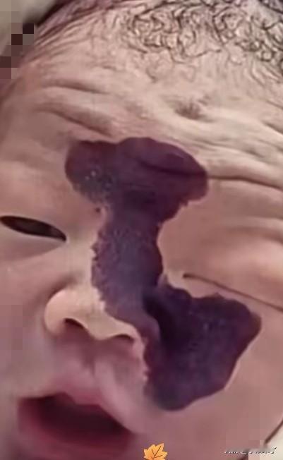 泪目！一对年轻夫妻，怀孕时在检查室看到宝宝脸上有一道黑影，医生说可能是胎记，丈夫