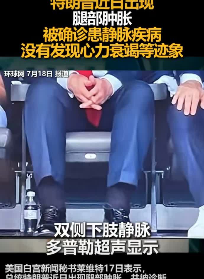 难道这不是因为和爱泼斯坦走得太近了的原故？所以，老董的脚都玩肿了[思考]？