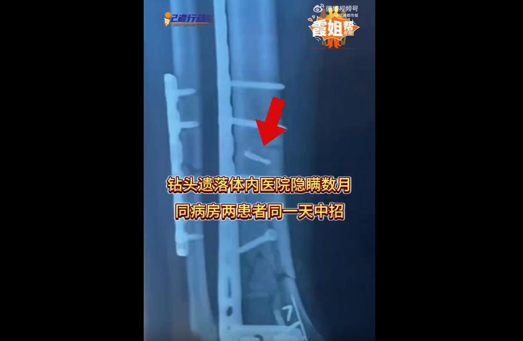 湖南祁阳中医医院两名同病房患者同日手术，体内均被遗落钻头。患者术后持续疼痛，多