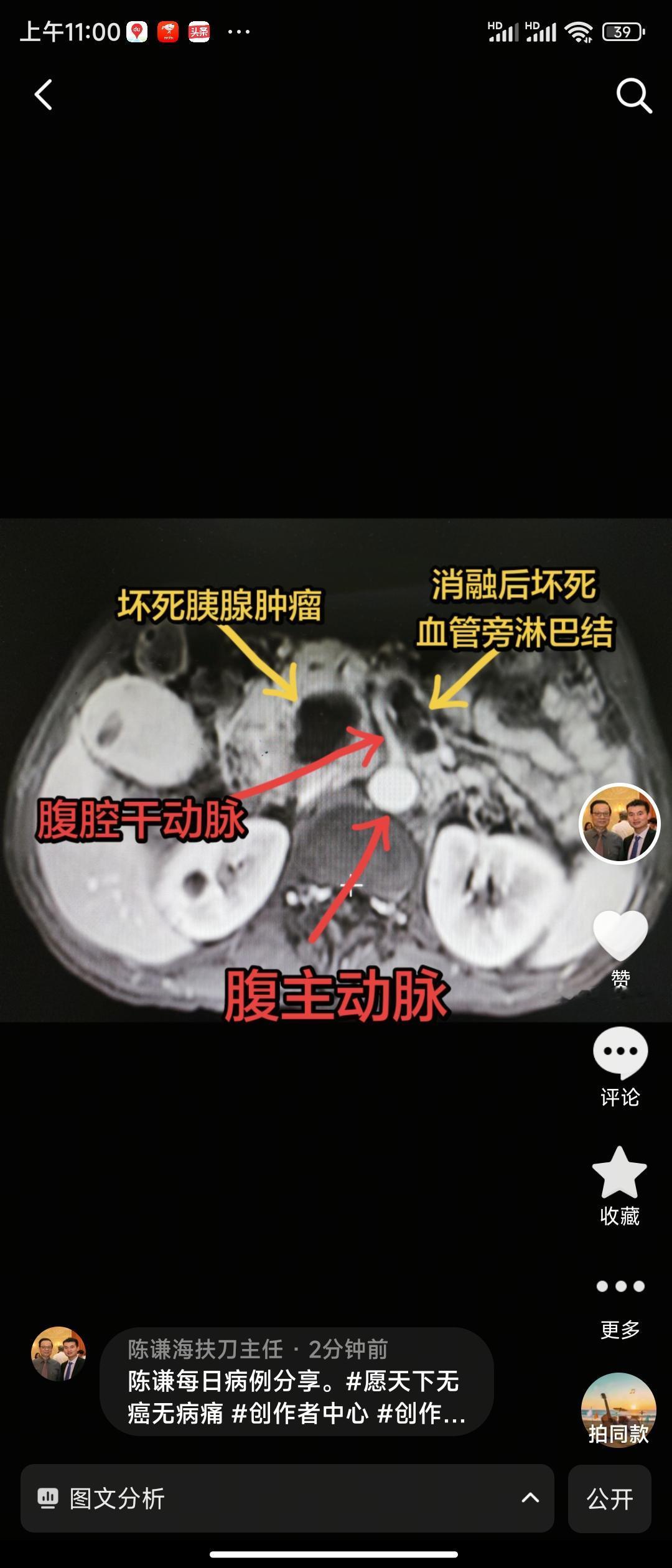 如何看待胰腺癌的生存率低这是一名胰腺癌复查增强磁共振，肿瘤坏死明显，腹腔干动脉旁