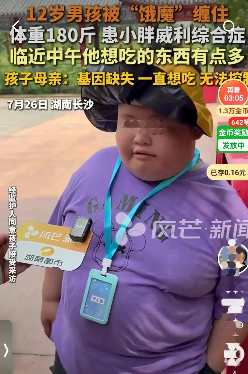 12岁男孩患小胖威利综合征，基因缺失引发的“饿魔”困境最近，湖南长沙一名1