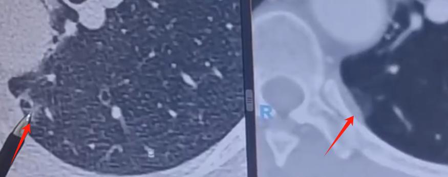 这位肺结节患者是幸运的,但她的做法我并不认同!一位50岁左右的女士,发现一个8m