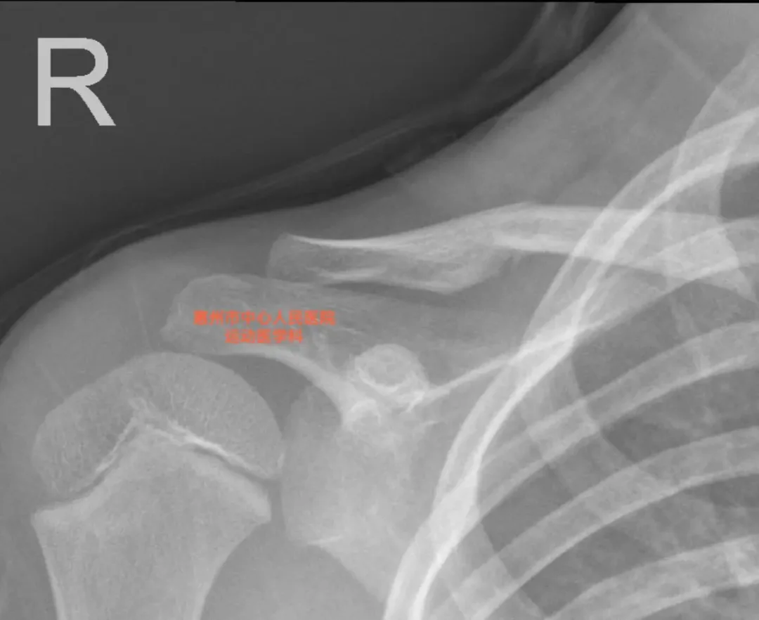 儿童锁骨骨折要不要做手术？