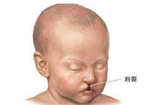 孕检查出胎儿“唇腭裂”, 生还是不生?