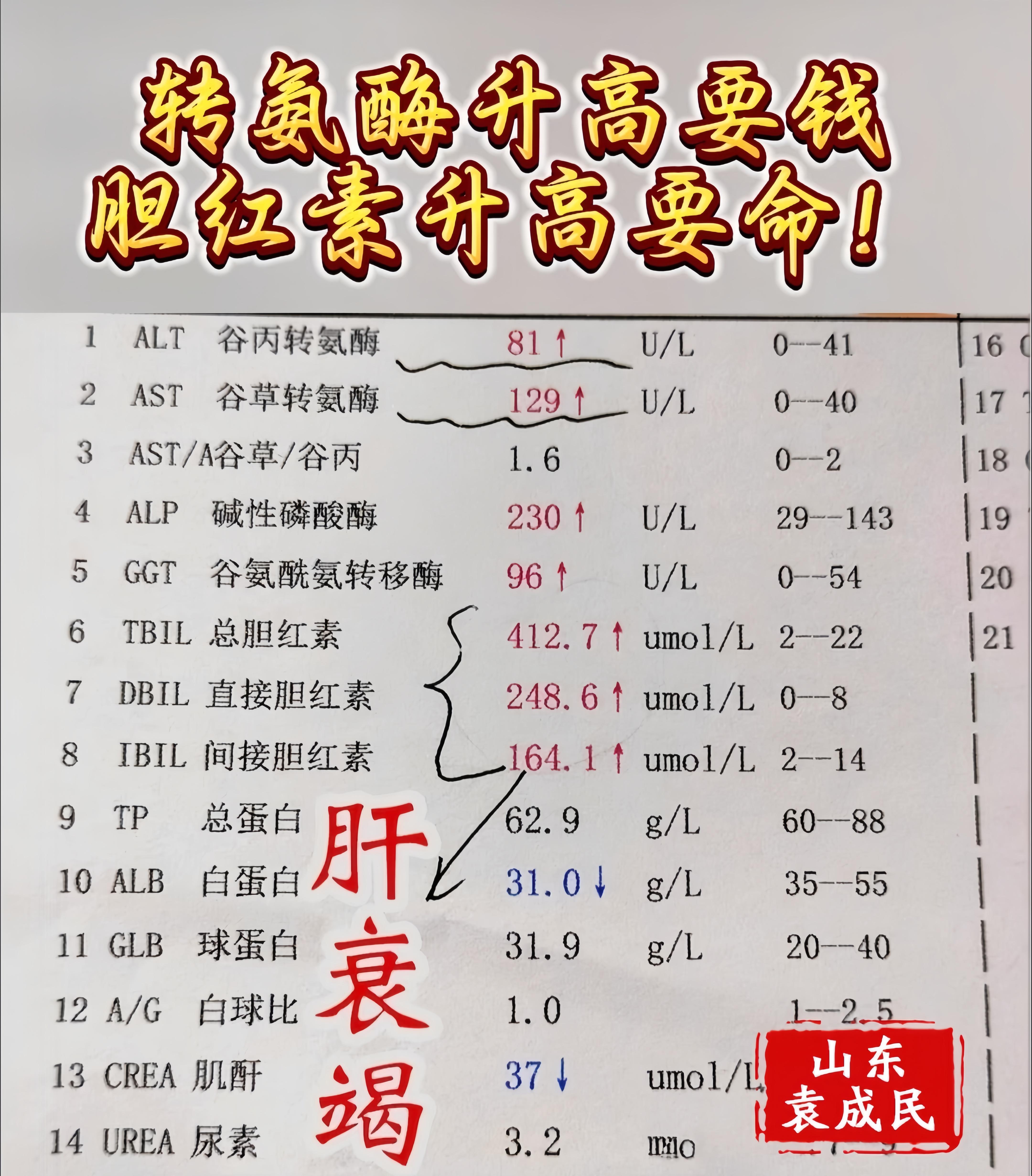在肝功能检测中，出现转氨酶（如ALT）水平正常或轻微升高，而胆红素水平...