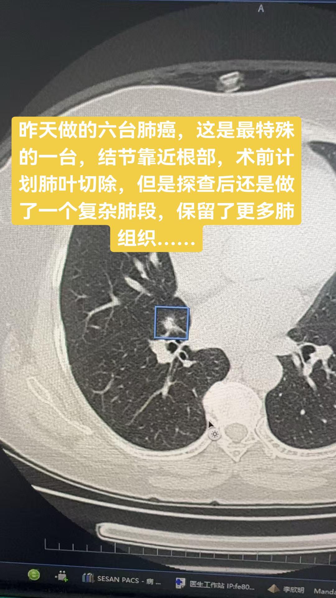 昨天做的六台肺癌，这是最特殊的一台，结节靠近根部，术前计划肺叶切除，但...