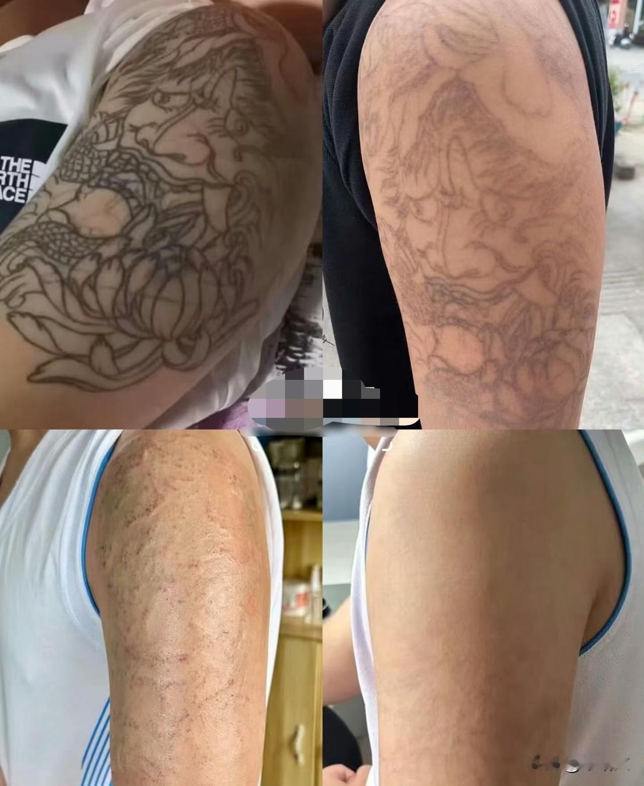 1500纹的身15000洗！姑娘痛到发抖：这哪是祛疤，是扒层皮“纹身150