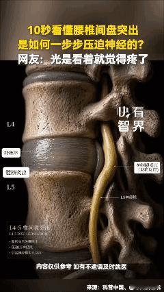 10秒看懂腰椎间盘突出是如何一步步压迫神经的？网友：光是看着就觉得疼了🥲