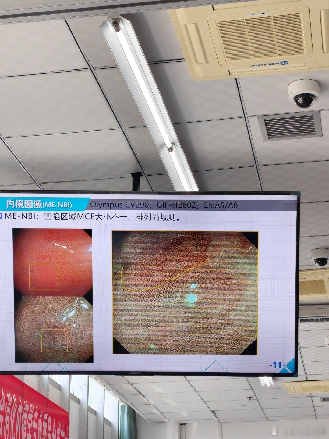 消化道早癌还是很有意思，目标明确，就是发现早癌，并处理。随着AI的发展，很多单一