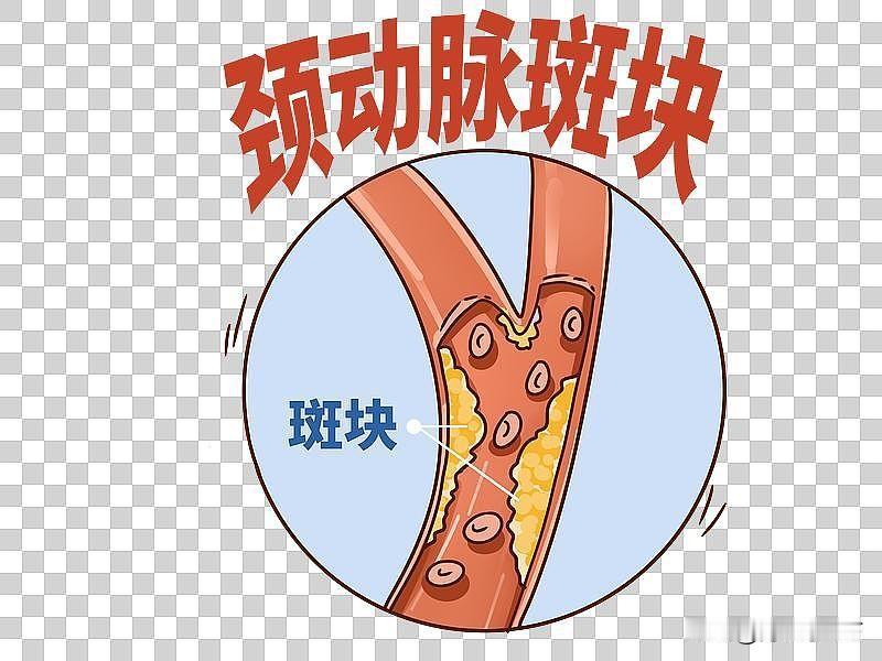 有颈动脉斑块该怎么办?查出颈动脉斑块别害怕，重点是稳住斑块，预防脑梗。