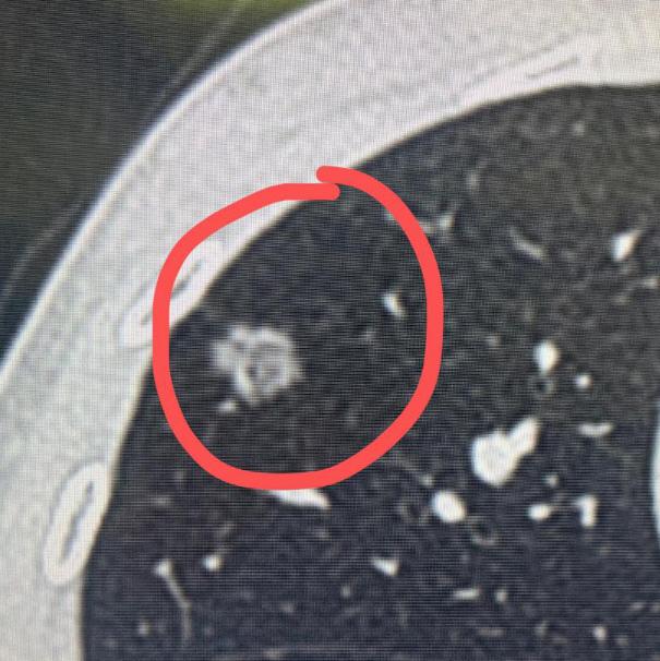 作为一名外科医生，说实话，切瘤子这事儿，对我们来说真不算难，熟能生巧，操作起来都