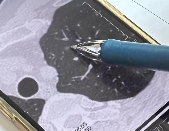 又是增强CT！最近门诊看肺小结节，总碰到病人拿着增强CT来问我该不该手术，或者复