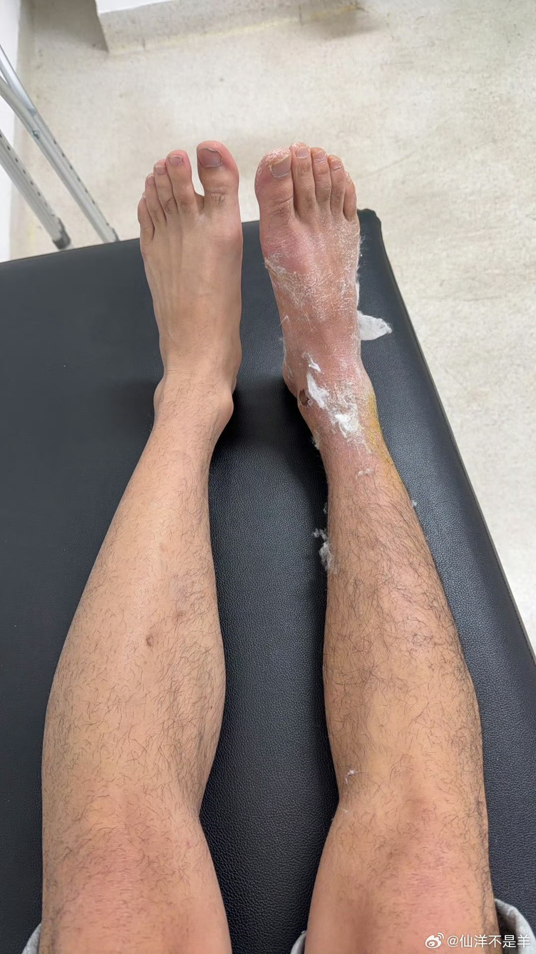 仙洋拆石膏了，腿瘦成啥了。