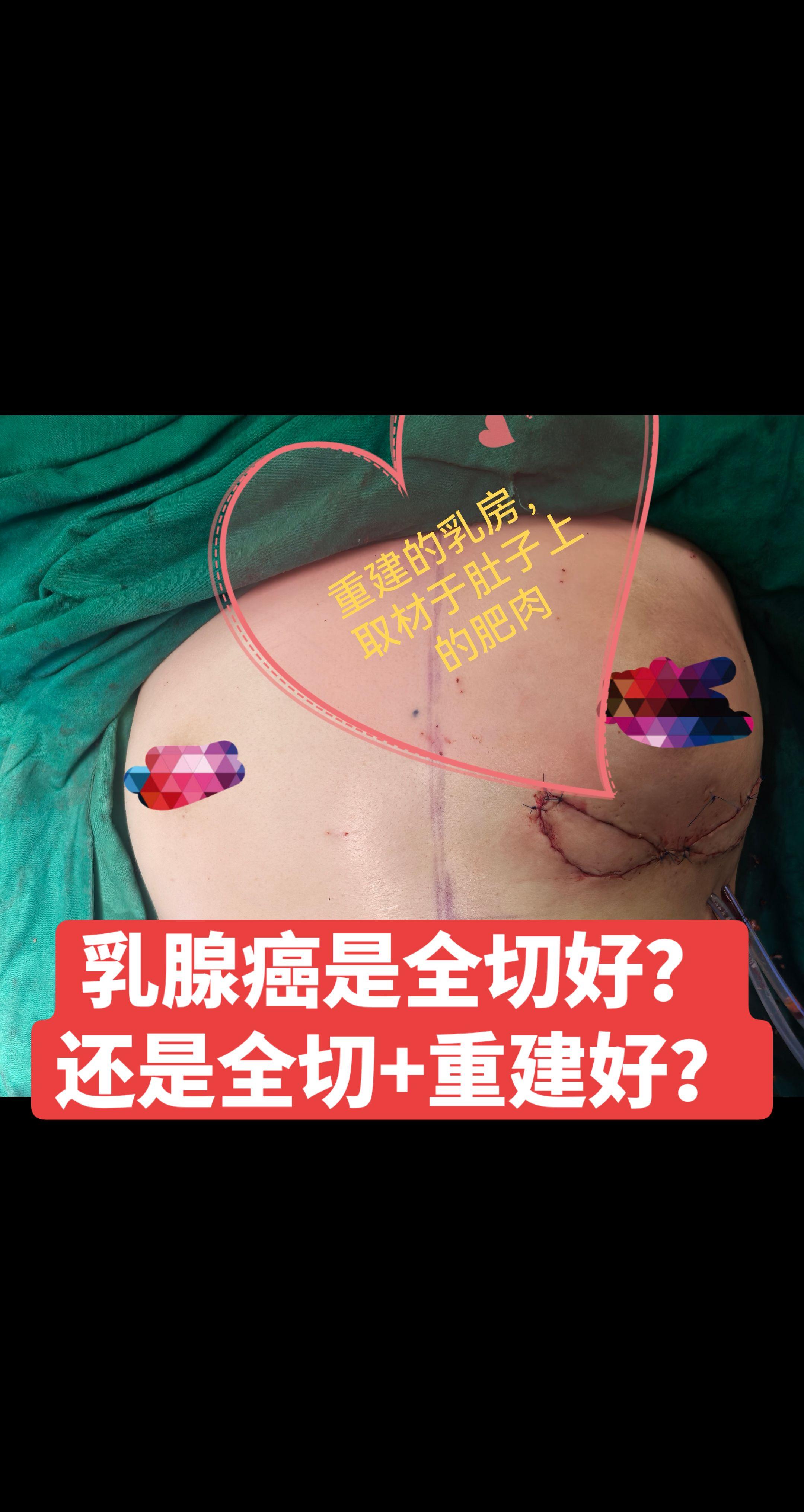 乳腺癌是全切好？还是全切+重建好？乳腺癌术后科普：全切好，还是全切后重...