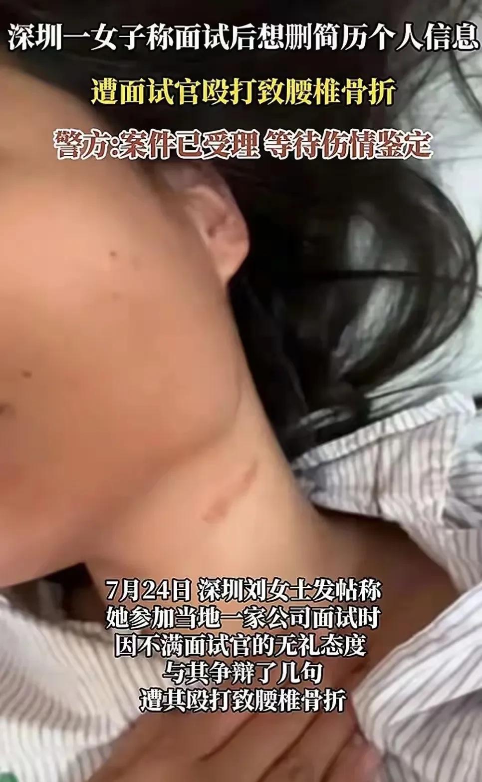 #分享城市新鲜事#深圳老板恶劣面试殴打女面试者致腰椎骨折！近日，女子去深圳某服装