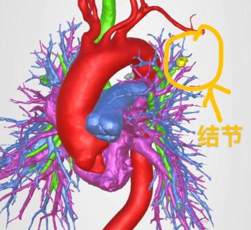 这位68岁的阿姨来看诊的时候，连爬二楼都觉得吃力，她平时总觉得喘不上气、容易咳嗽