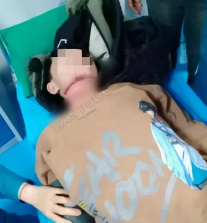 一个13岁的男孩，骑车上学的路上居然被一根绳子“割喉”了，气管食管全断，现在还在