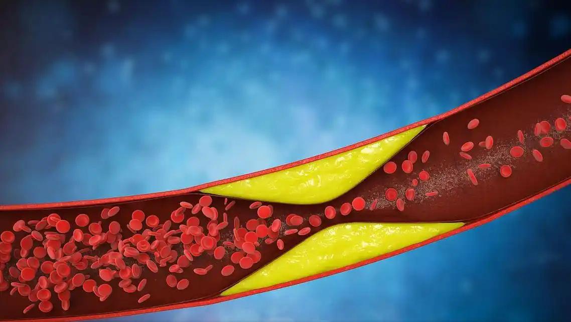 高血压的“真凶”找到了！不是盐，而是它！赶紧戒掉高血压不是吃盐太多，而是它偷