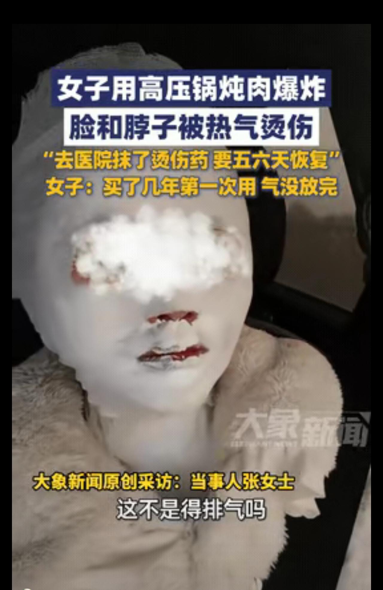 吓出冷汗！保定女子炖肉被高压锅烫伤，脸脖裹满纱布，这个致命错误很多人还在犯