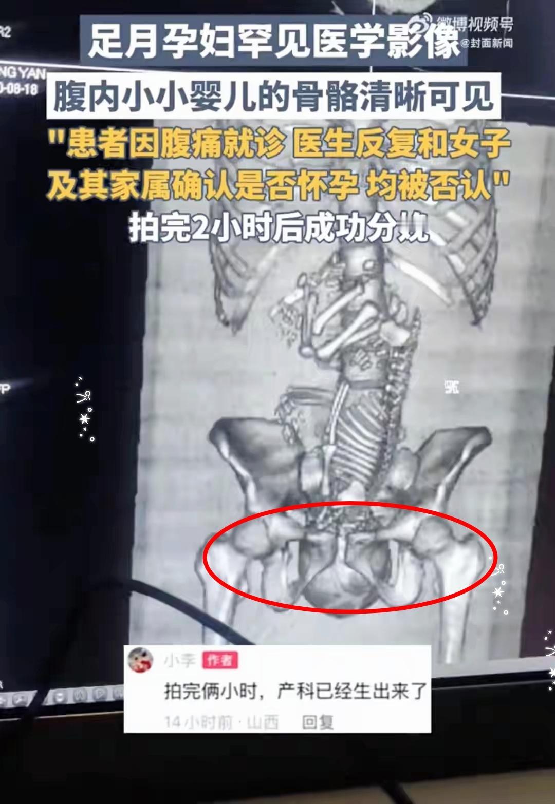 19岁姑娘捂着肚子去医院，医生反复问“是不是怀孕了”，她和家属一口咬定“没有”，