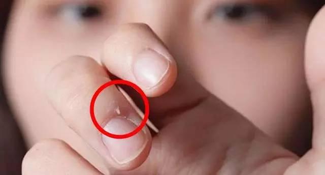 长倒刺, 不是因为缺维生素或微量元素, 而是缺少这个