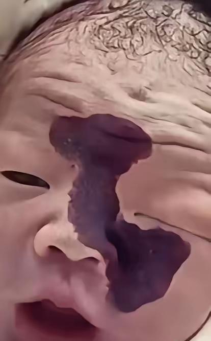 看哭了！一对年轻夫妻，怀孕时在检查室看到宝宝脸上有一道黑影，医生说可能是胎记，丈