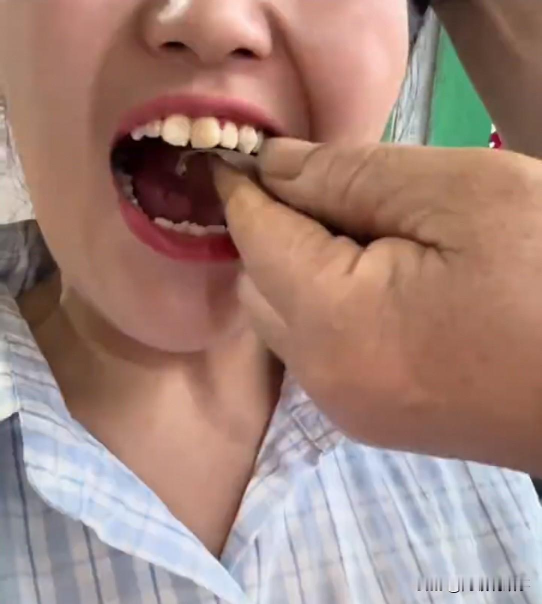 山东，女儿跟父母抱怨：“牙齿太尖，总扎嘴，又口腔溃疡。”老爸一拍脑门：“我有法子