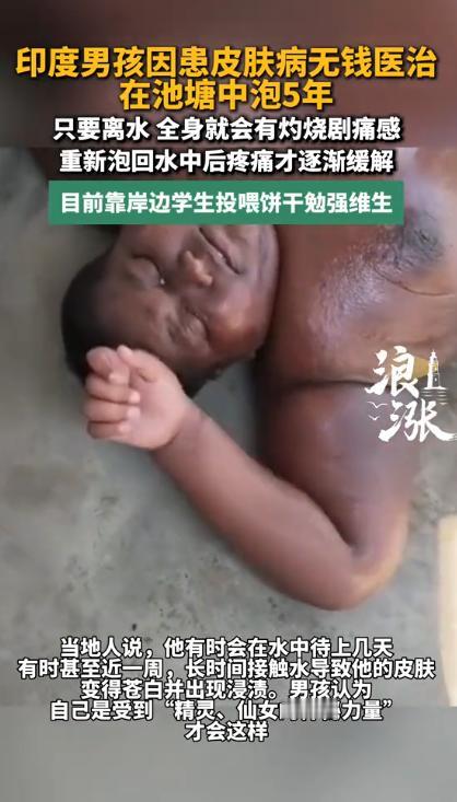 印度，一名16岁少年患上怪病，离开水就全身剧痛如火烧。家里穷看不起病，他只能常年