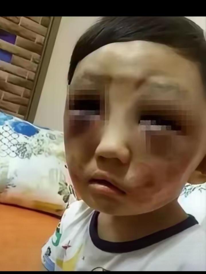 走了整整一天啊，一个才6岁的小豆丁。当妈的拽过孩子一看，青一块紫一块。颤着声