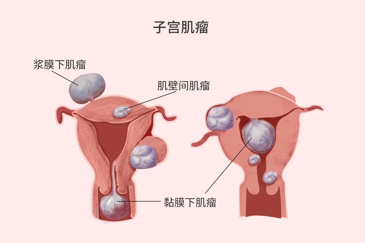 子宫肌瘤一定要切掉吗？体检报告上"子宫肌瘤"四个字，让很多女性瞬间紧张："是不是要手术？会不会癌变？