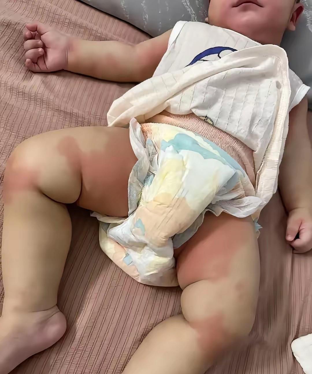 急哭！9月龄宝宝半夜突发红疹，我家9月龄宝宝昨晚喝完奶还好好的，睡下没多久就