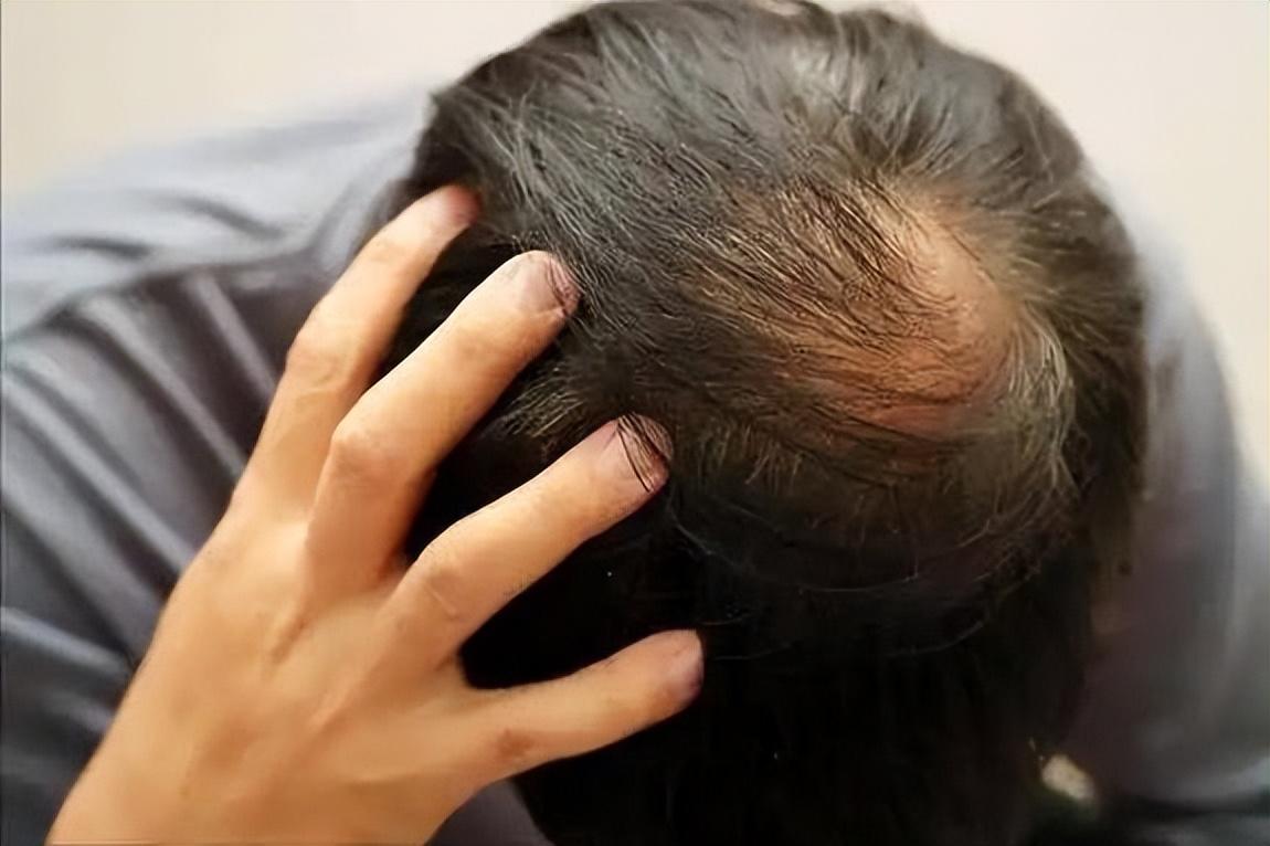 男性能活多久，看头发就知？提醒：若有这4症状，尽早引起重视！有些人刚到三十出