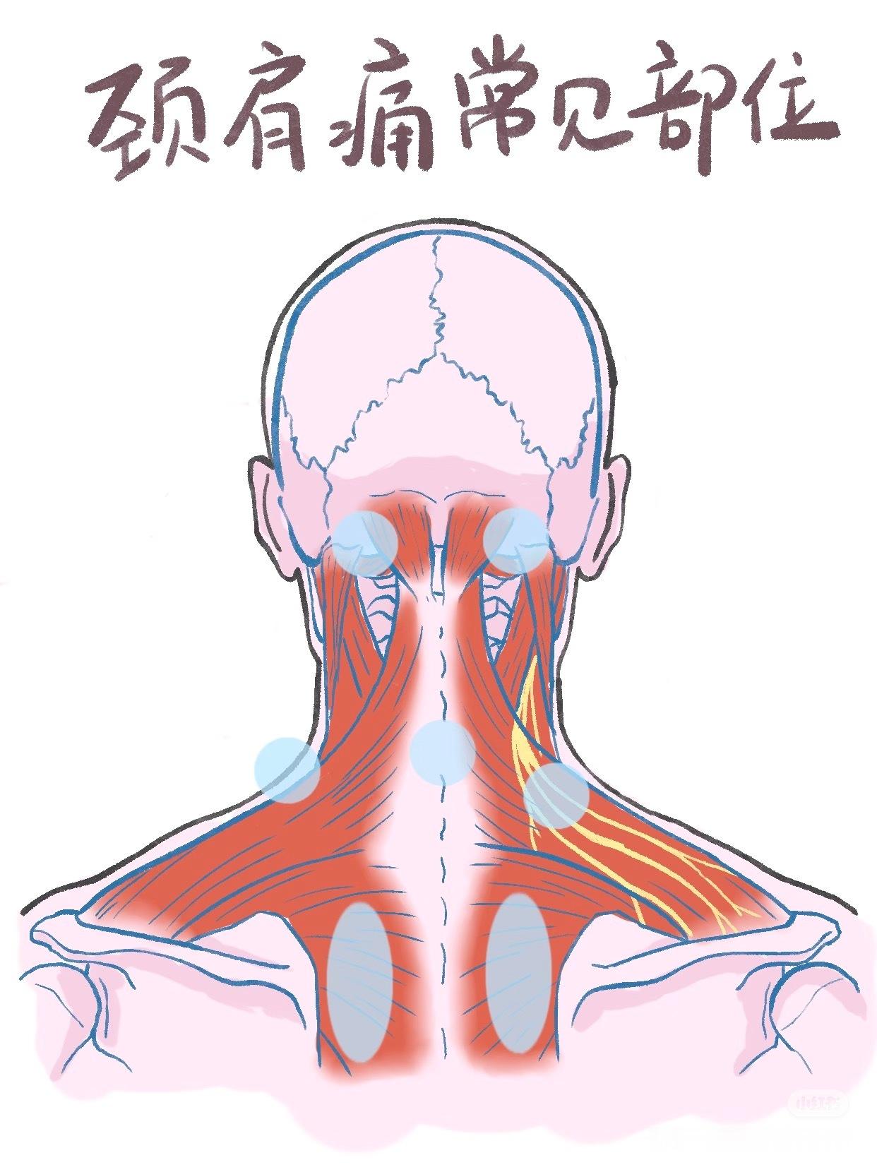 颈椎病【颈肩痛常见部位】低头族因长期保持前倾姿势，导致特定肌肉群和关节持续受压