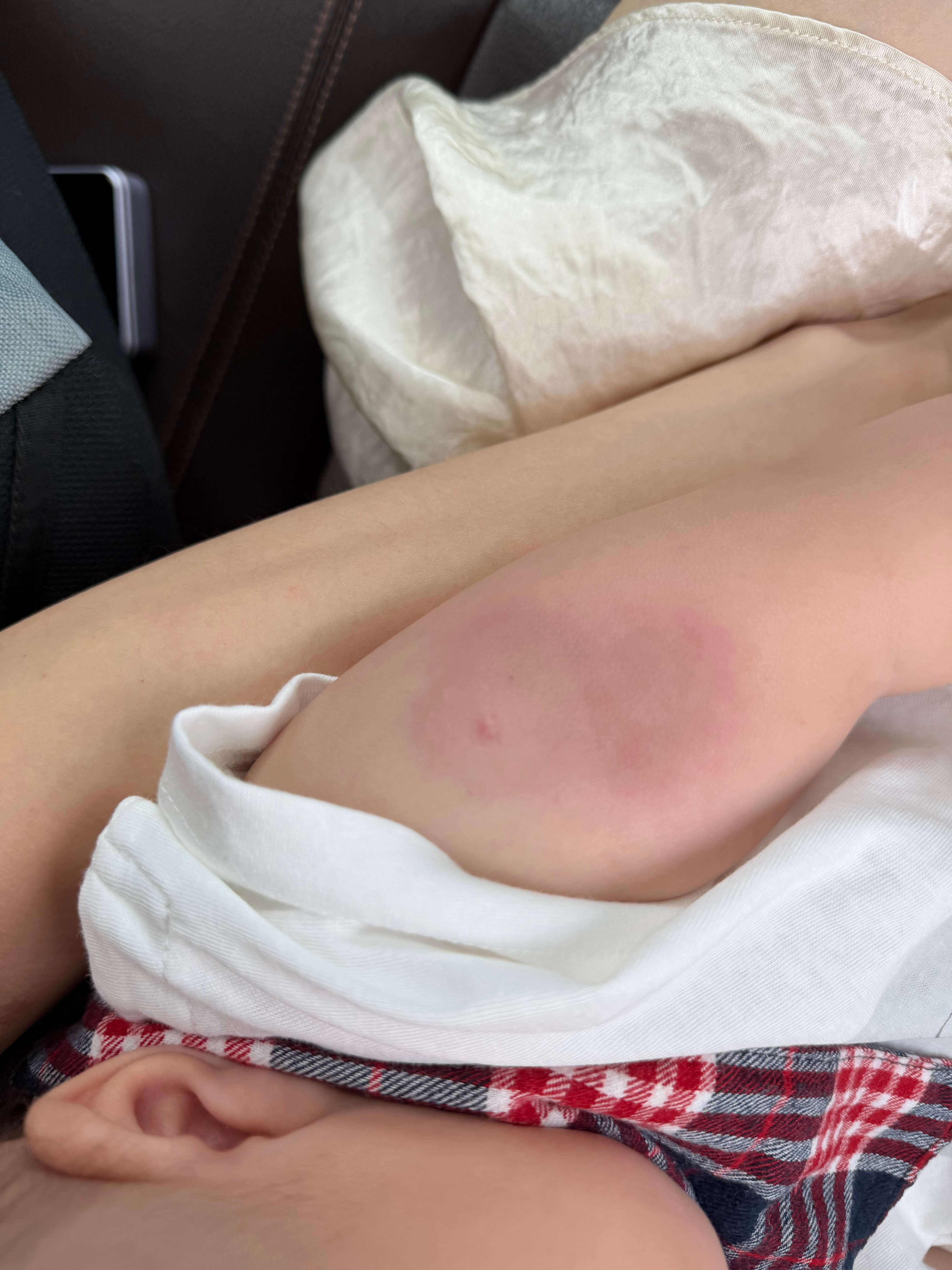 可恶的打疫苗！！！！！第一次红成这样