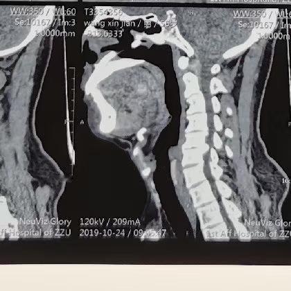 钙化的颈椎间盘突出手术有一定难度，慎入！