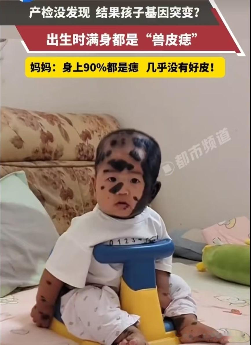 宝宝产检正常出生后满身兽皮痣！近日，河南，一位妈妈发视频称自己孩子“身上90