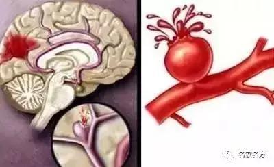 会不会脑梗, 画个圈就知道! 一种小零食专破脑梗, 非常了得~