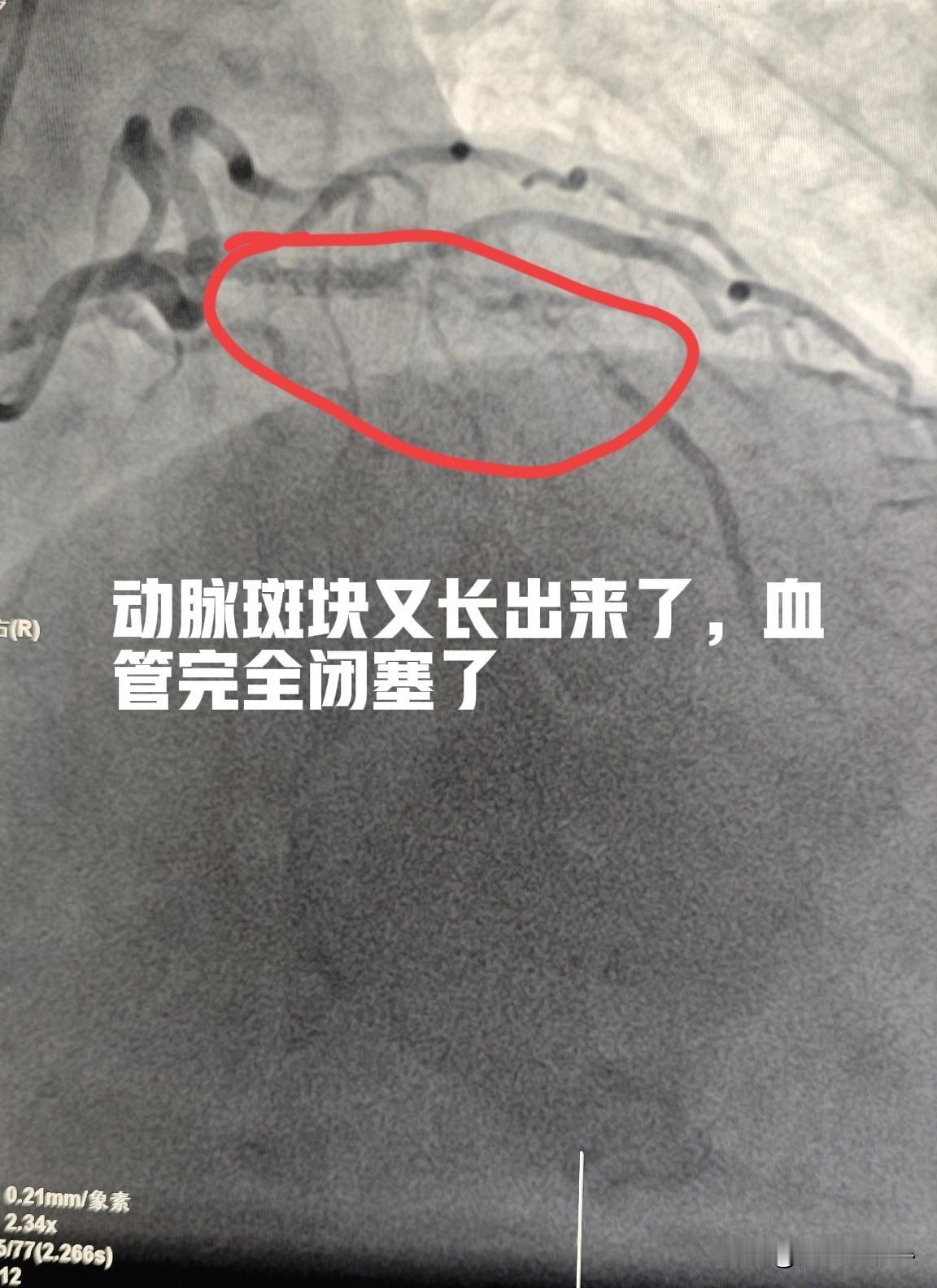 做了心脏支架还抽烟，后果有多严重？18岁男性患者，5年前做了心脏支架，前降支做