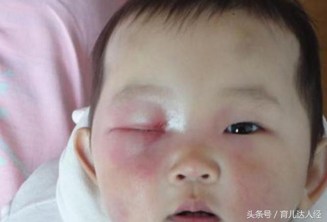 孩子出生后头上长脓包, 母亲很着急, 医院一查才放心